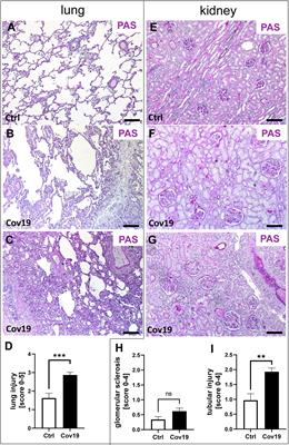 Complement Activation via the Lectin and Alternative Pathway in Patients With Severe COVID-19